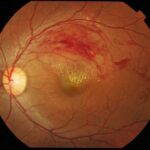 Retinal Vein Occlusion